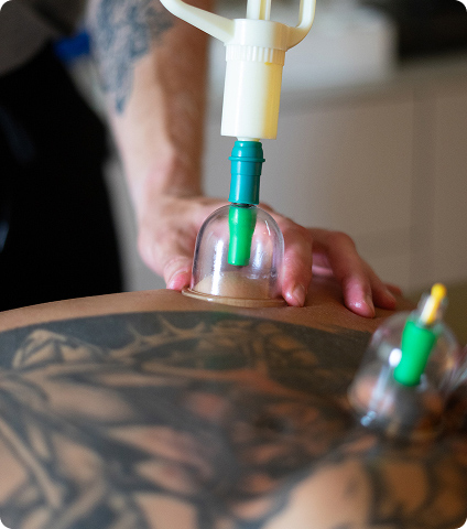 Cupping Therapy